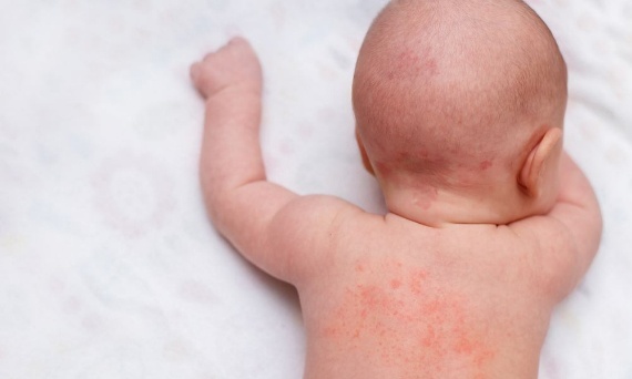 Jak zapobiegać przegrzaniu dziecka i jakie są tego objawy?